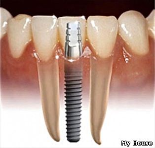 Имплантация зубов